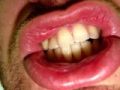 Scientists discover way to regenerate teeth with lasers